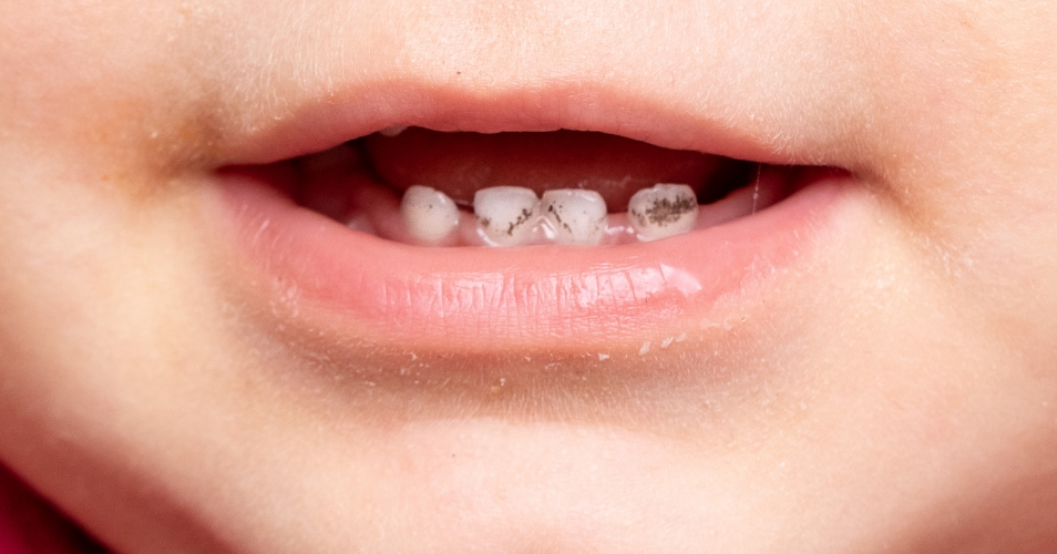Pigmentação dos dentes